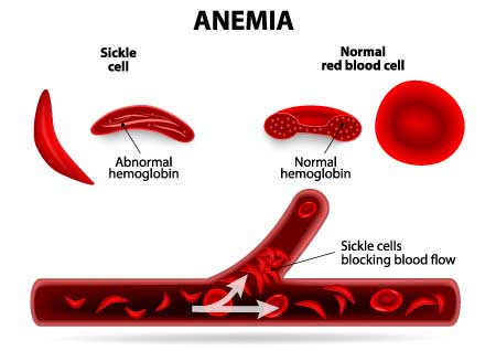 Sickle Cell Anemia Treatment in Gatlinburg, TN